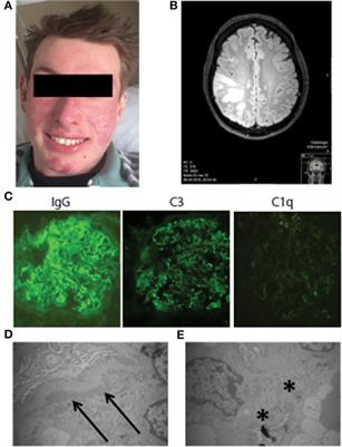 C1q Deficiency and Neuropsychiatric Systemic Lupus Erythematosus